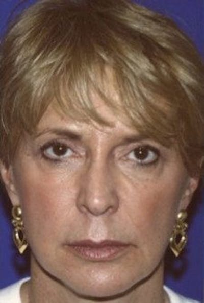Facelift Before & After Gallery - Patient 314317 - Image 1