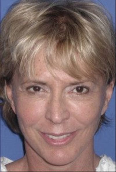 Facelift Before & After Gallery - Patient 314317 - Image 2