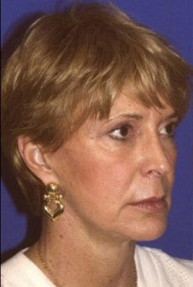 Face Lift Before & After Gallery - Patient 314317 - Image 3