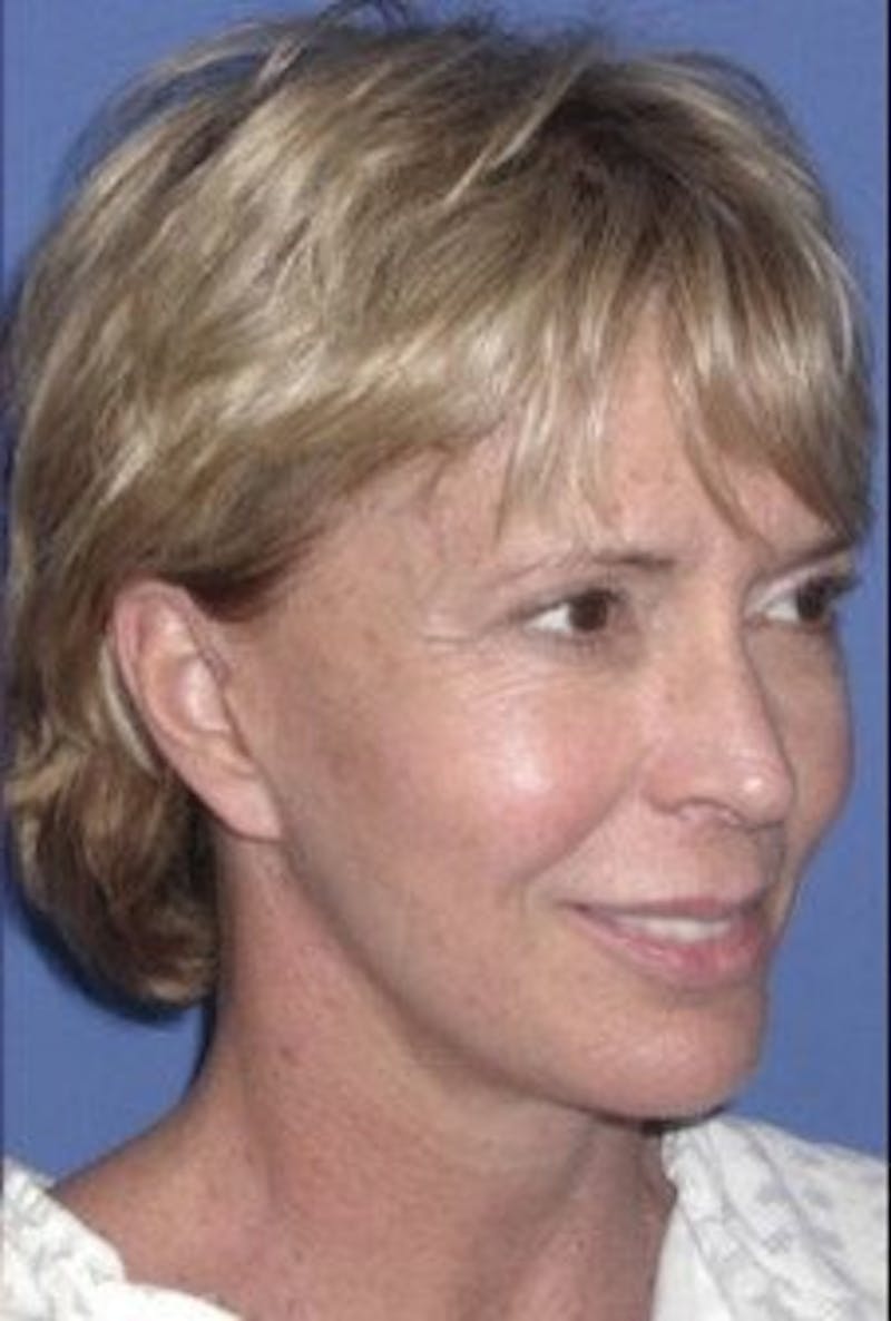 Face Lift Before & After Gallery - Patient 314317 - Image 4