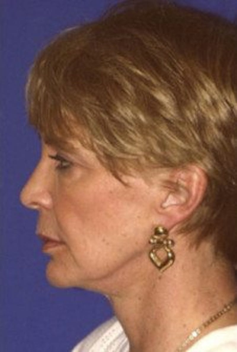 Face Lift Before & After Gallery - Patient 314317 - Image 5