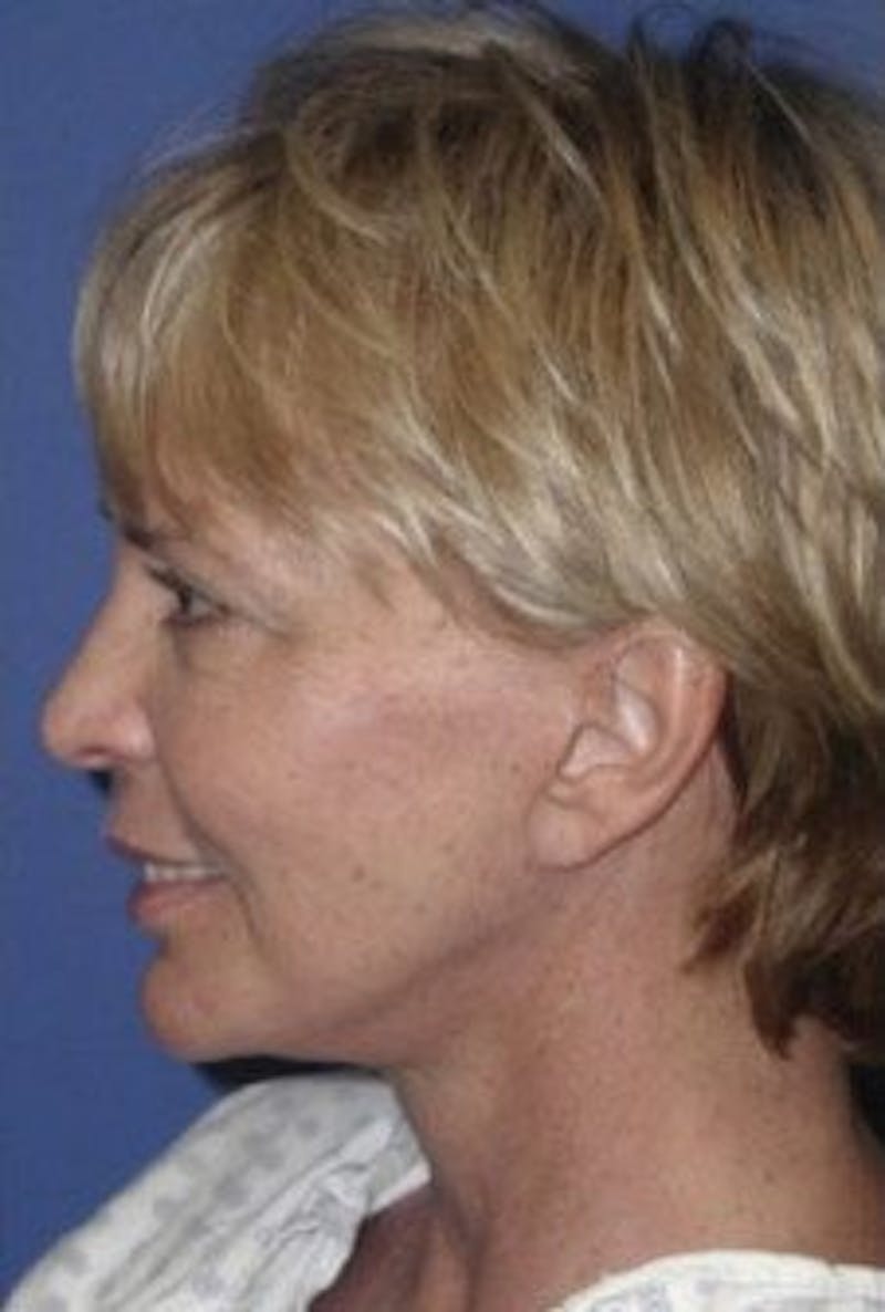 Face Lift Before & After Gallery - Patient 314317 - Image 6