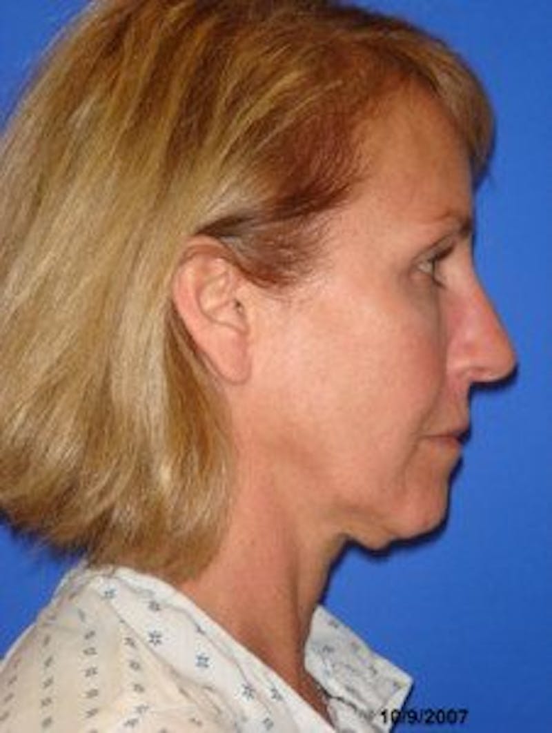 Face Lift Before & After Gallery - Patient 713960 - Image 3