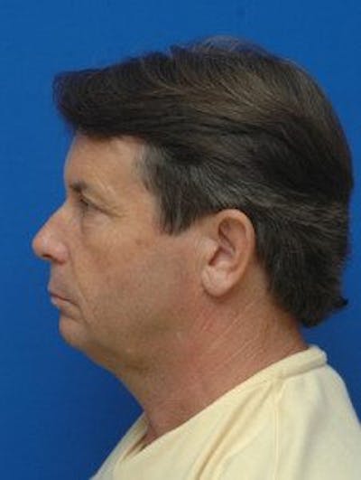 Facelift Before & After Gallery - Patient 131941 - Image 1