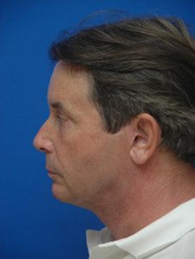 Facelift Before & After Gallery - Patient 131941 - Image 2