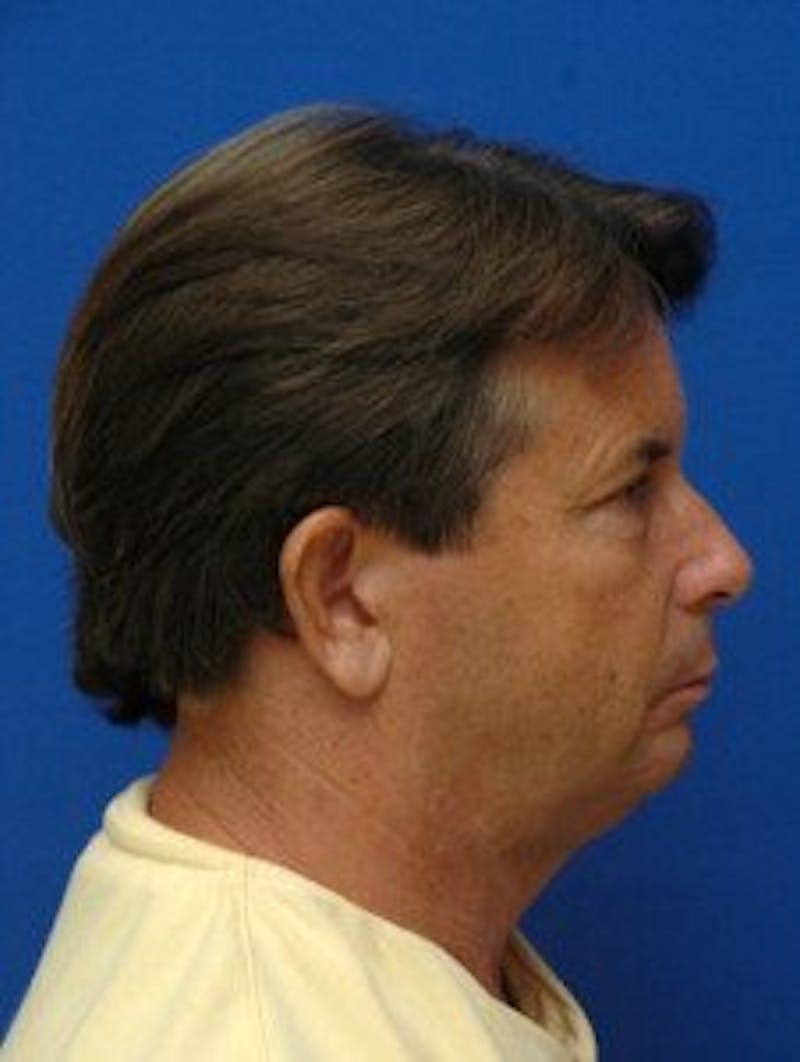 Face Lift Before & After Gallery - Patient 131941 - Image 3