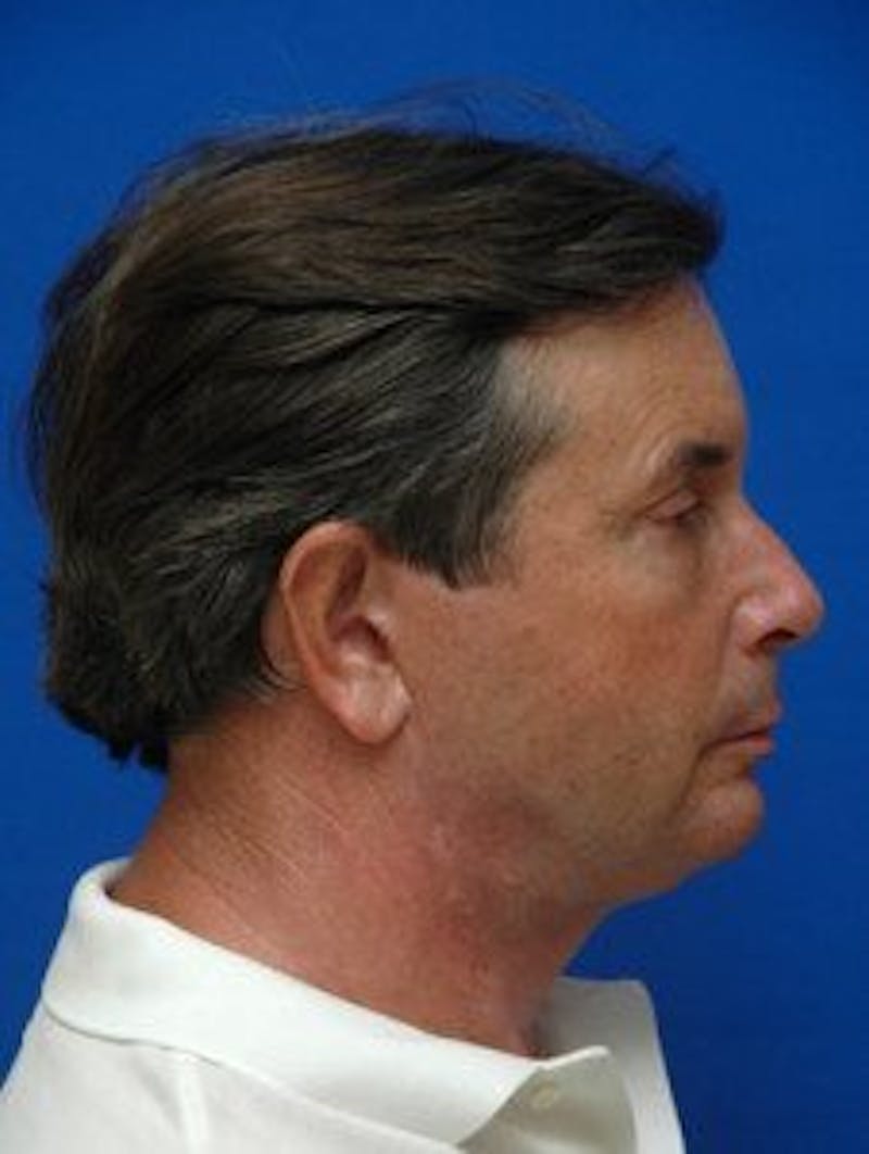 Face Lift Before & After Gallery - Patient 131941 - Image 4