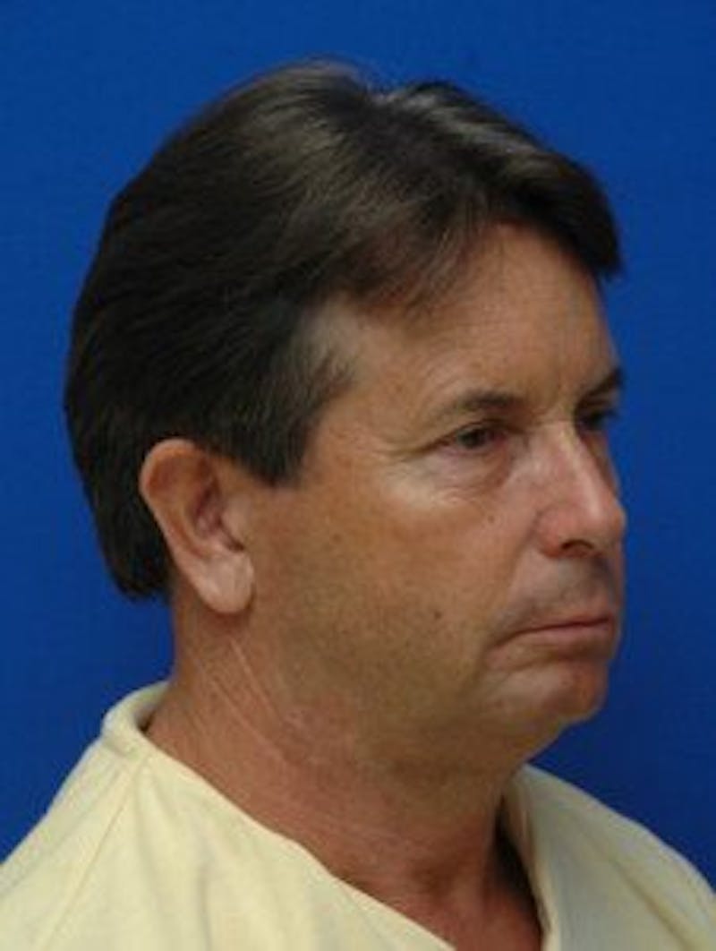 Face Lift Before & After Gallery - Patient 131941 - Image 5