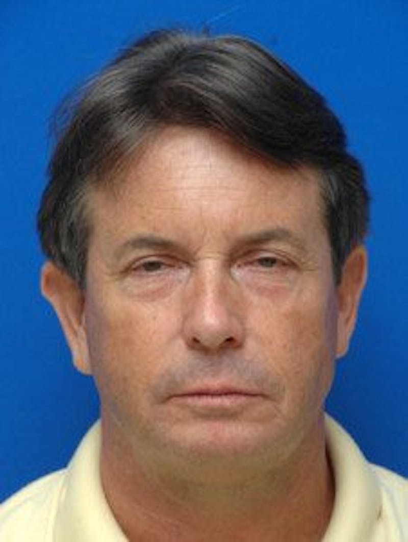 Face Lift Before & After Gallery - Patient 131941 - Image 7
