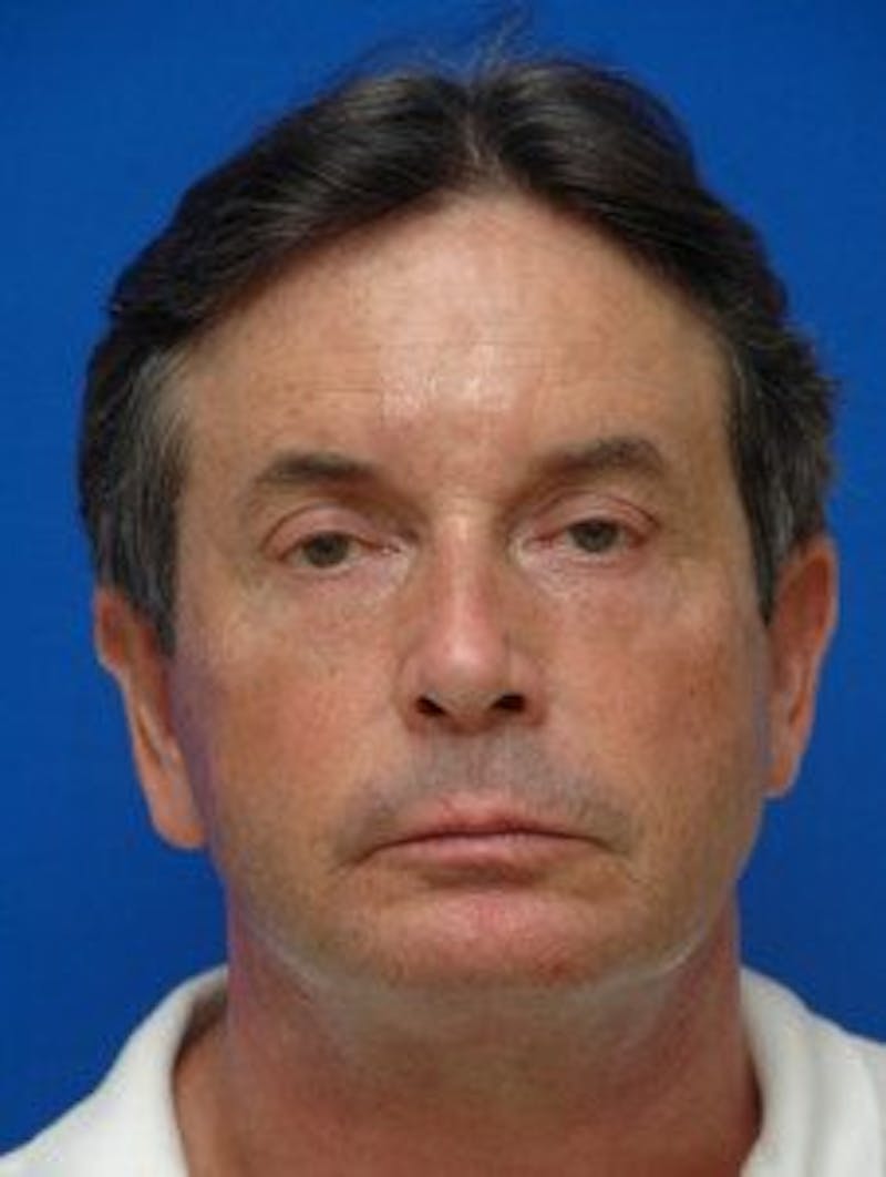 Face Lift Before & After Gallery - Patient 131941 - Image 8