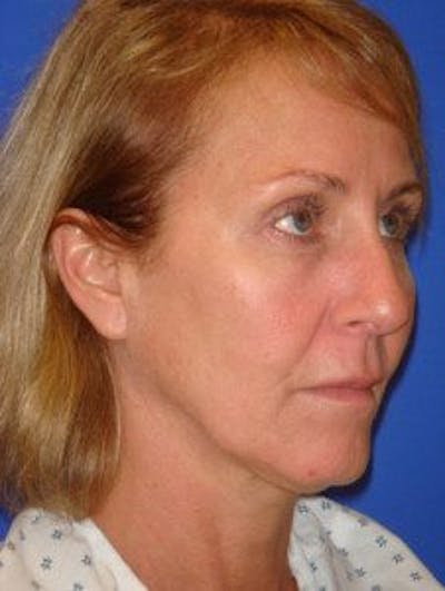 Facelift Before & After Gallery - Patient 713960 - Image 1