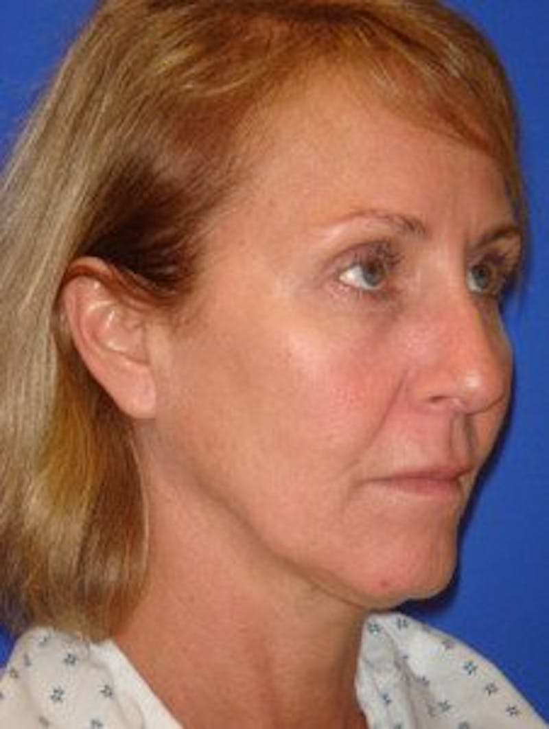 Face Lift Before & After Gallery - Patient 713960 - Image 1