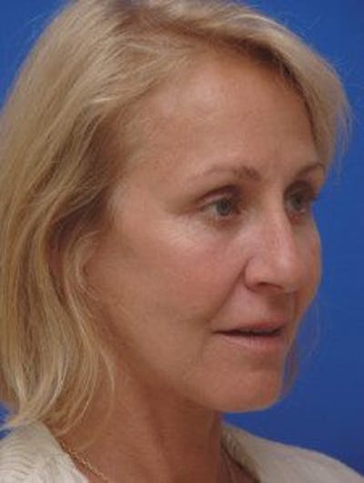 Facelift Before & After Gallery - Patient 713960 - Image 2