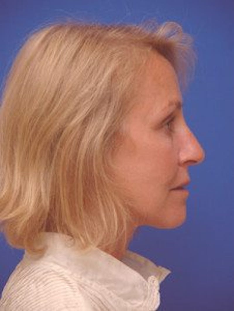 Face Lift Before & After Gallery - Patient 713960 - Image 4