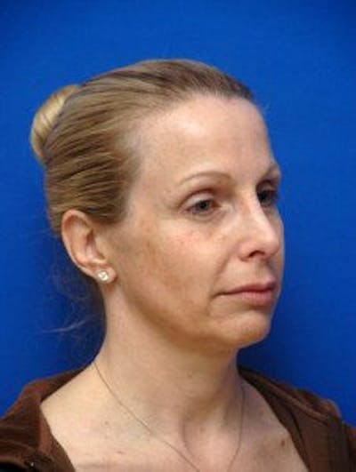 Facelift Before & After Gallery - Patient 105525 - Image 1