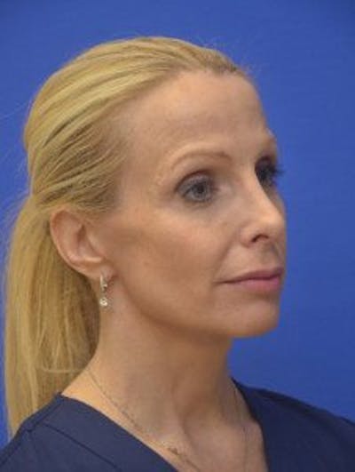Facelift Before & After Gallery - Patient 105525 - Image 2