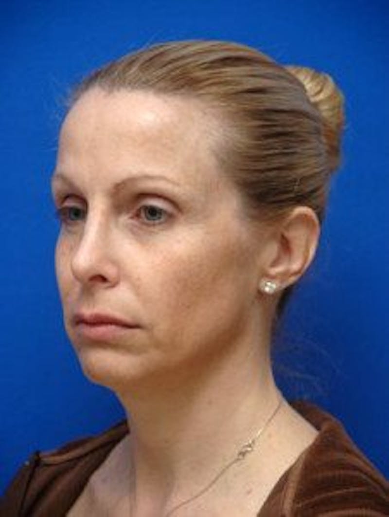 Face Lift Before & After Gallery - Patient 105525 - Image 3