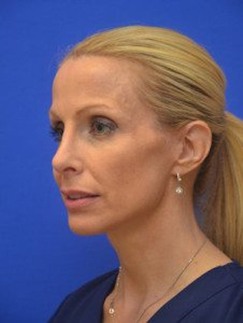 Face Lift Before & After Gallery - Patient 105525 - Image 4