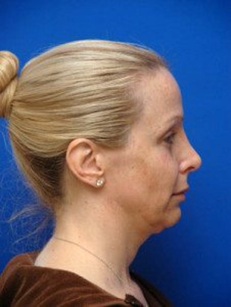 Face Lift Before & After Gallery - Patient 105525 - Image 5