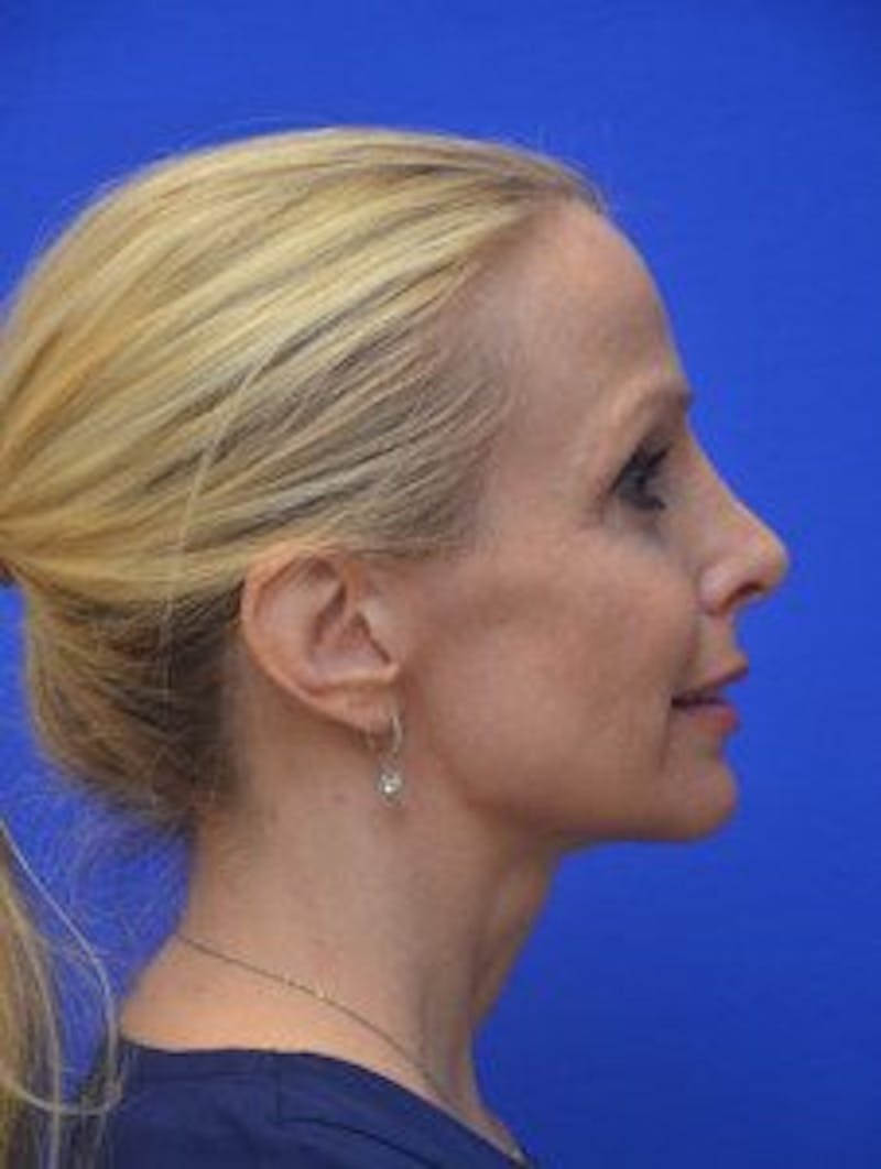 Face Lift Before & After Gallery - Patient 105525 - Image 6