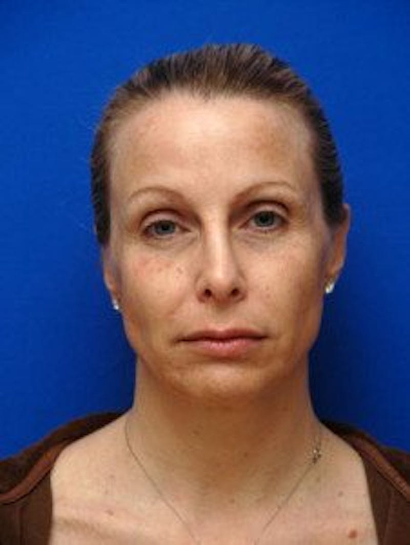 Face Lift Before & After Gallery - Patient 105525 - Image 7