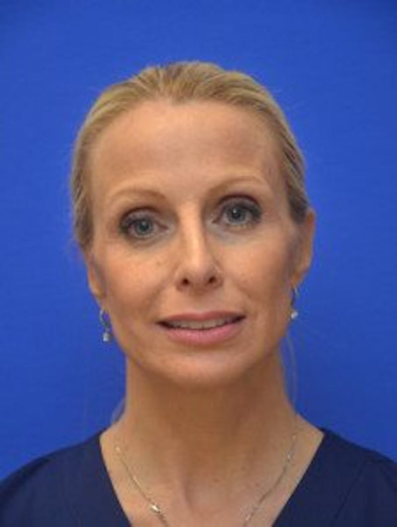 Face Lift Before & After Gallery - Patient 105525 - Image 8