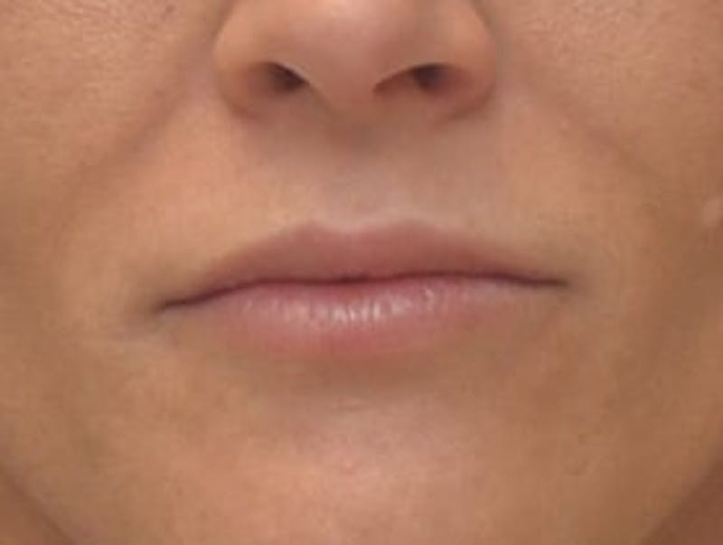 Lip Augmentation Before & After Gallery - Patient 367633 - Image 1