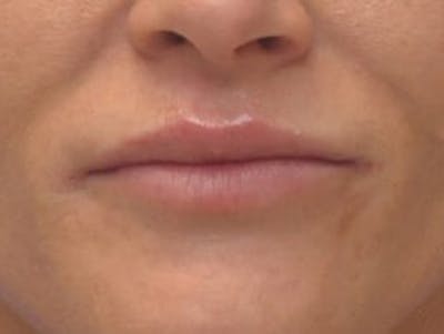 Lip Augmentation Before & After Gallery - Patient 367633 - Image 2