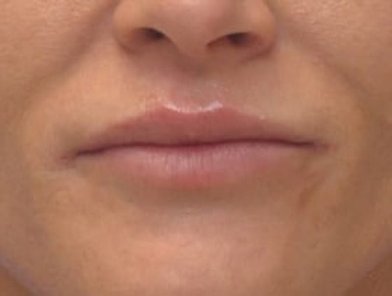 Lip Augmentation Before & After Gallery - Patient 367633 - Image 2
