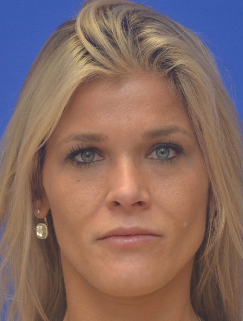 Lip Augmentation Before & After Gallery - Patient 367633 - Image 3