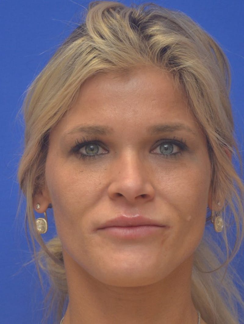 Lip Augmentation Before & After Gallery - Patient 367633 - Image 4