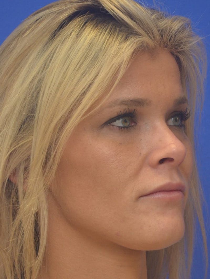 Lip Augmentation Before & After Gallery - Patient 367633 - Image 5