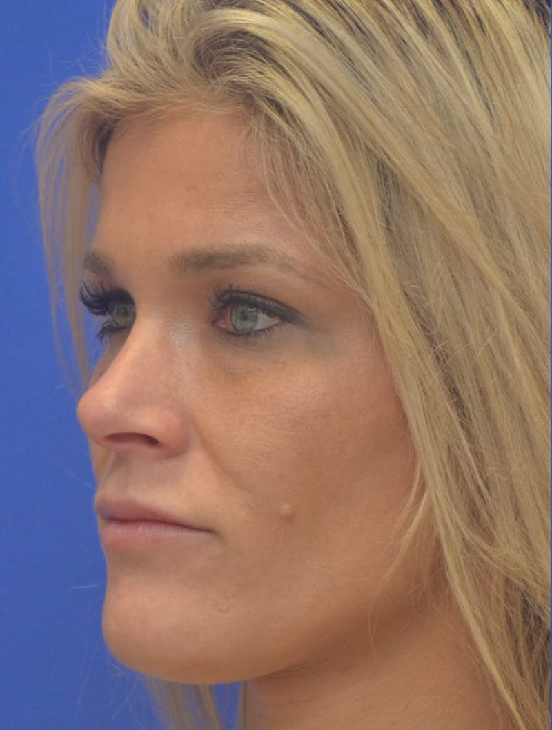 Lip Augmentation Before & After Gallery - Patient 367633 - Image 7
