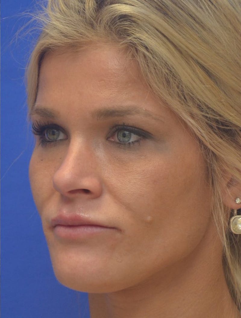 Lip Augmentation Before & After Gallery - Patient 367633 - Image 8