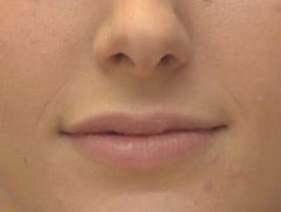 Lip Augmentation Before & After Gallery - Patient 277518 - Image 1
