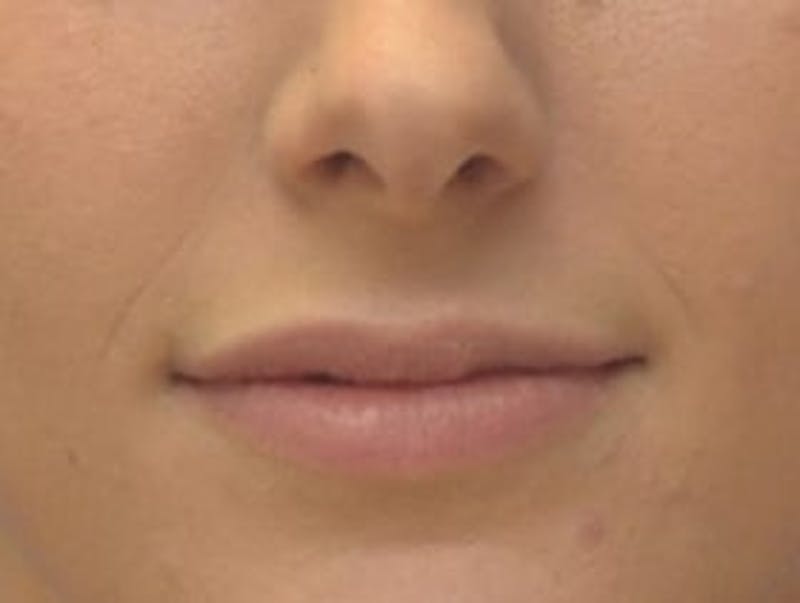 Lip Augmentation Before & After Gallery - Patient 277518 - Image 1