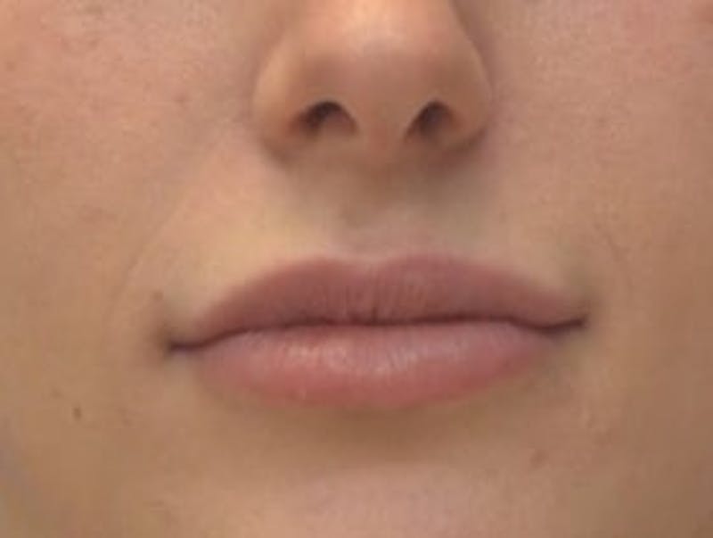 Lip Augmentation Before & After Gallery - Patient 277518 - Image 2