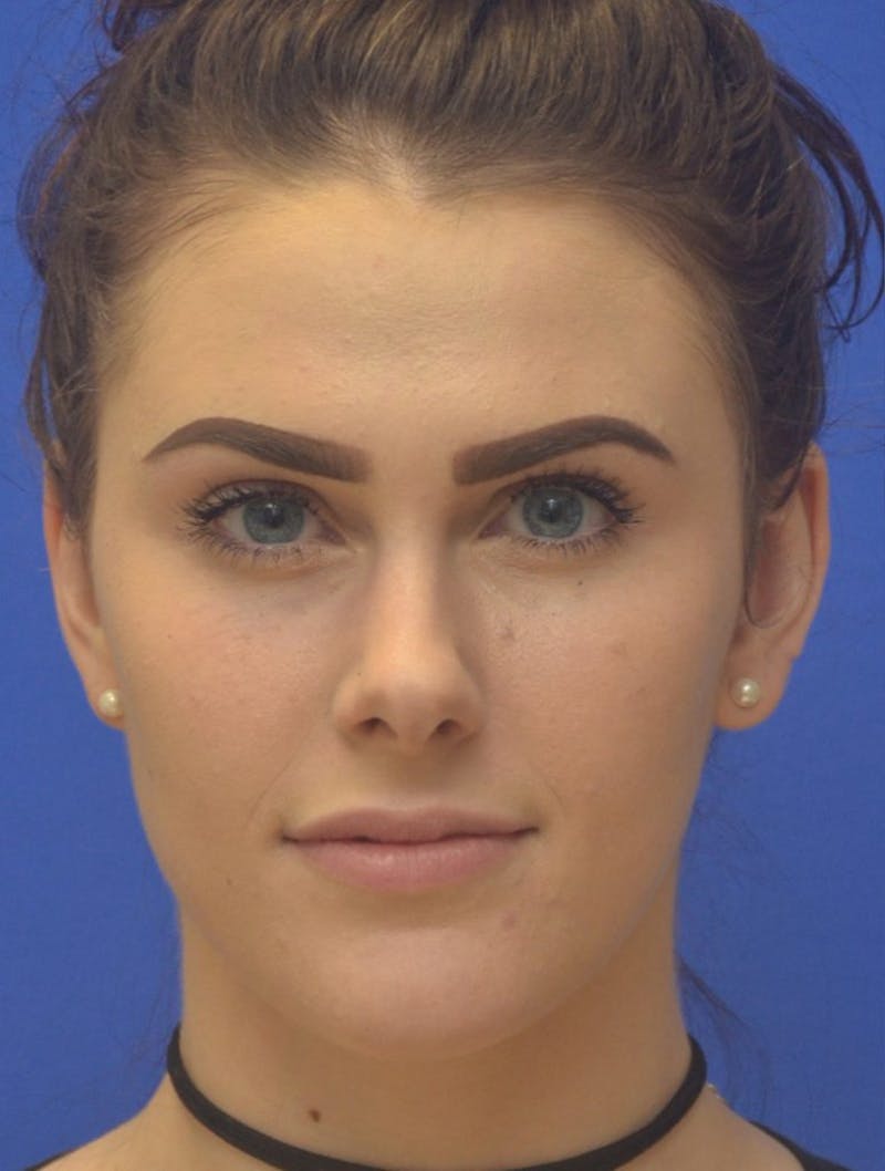 Lip Augmentation Before & After Gallery - Patient 277518 - Image 3