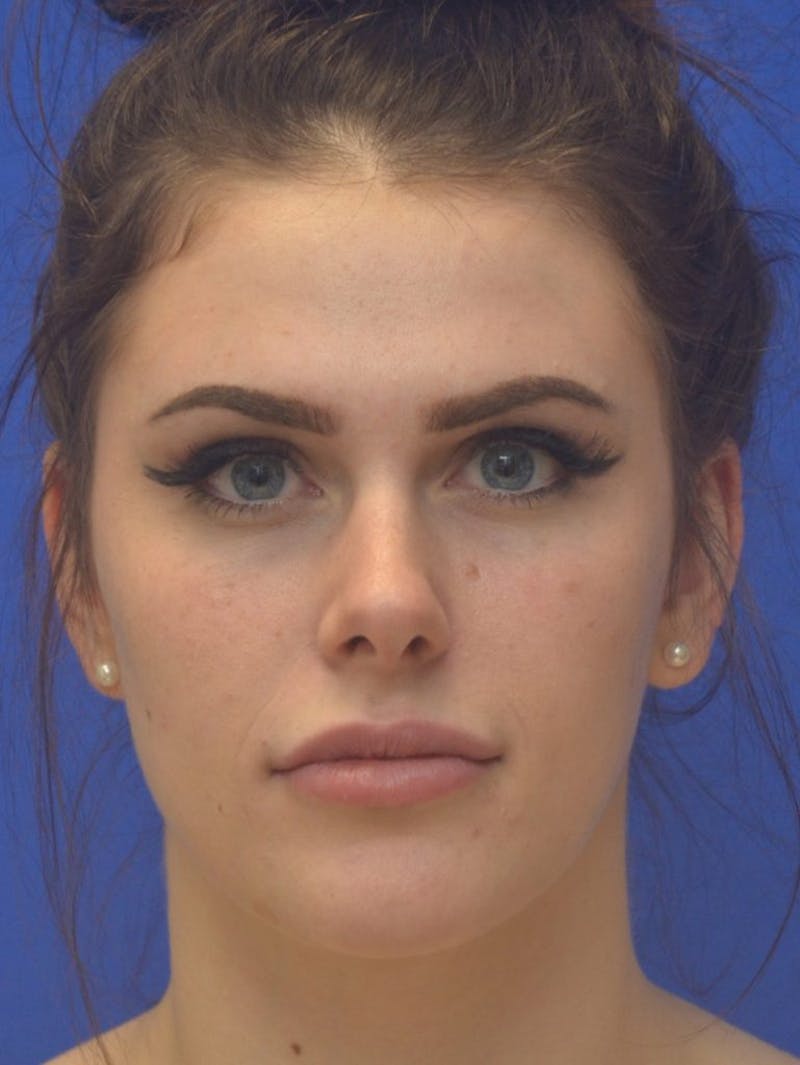 Lip Augmentation Before & After Gallery - Patient 277518 - Image 4