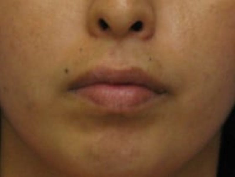 Lip Augmentation Before & After Gallery - Patient 174290 - Image 1