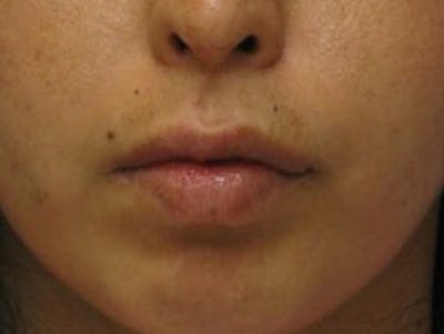 Lip Augmentation Before & After Gallery - Patient 174290 - Image 2