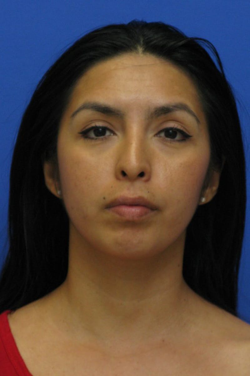 Lip Augmentation Before & After Gallery - Patient 174290 - Image 3