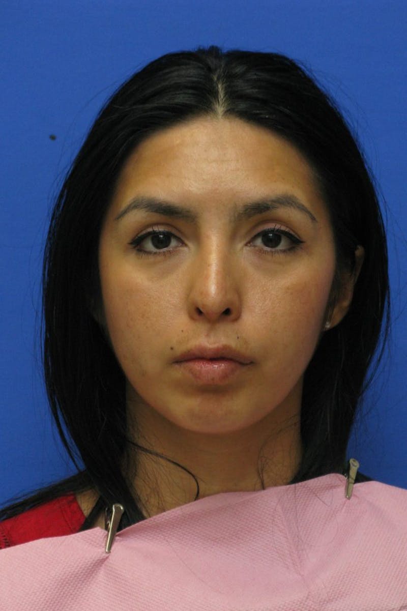 Lip Augmentation Before & After Gallery - Patient 174290 - Image 4