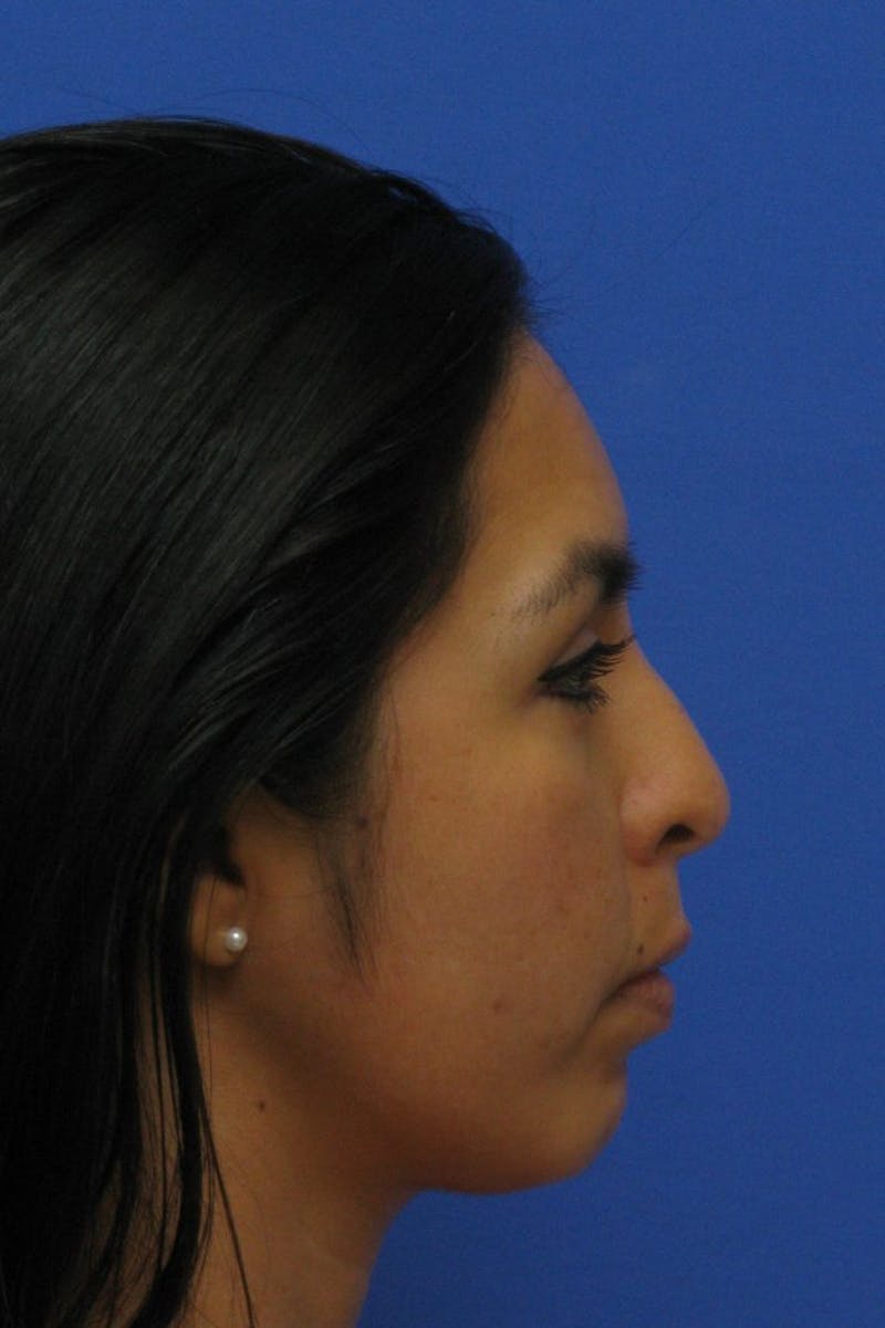 Lip Augmentation Before & After Gallery - Patient 174290 - Image 5