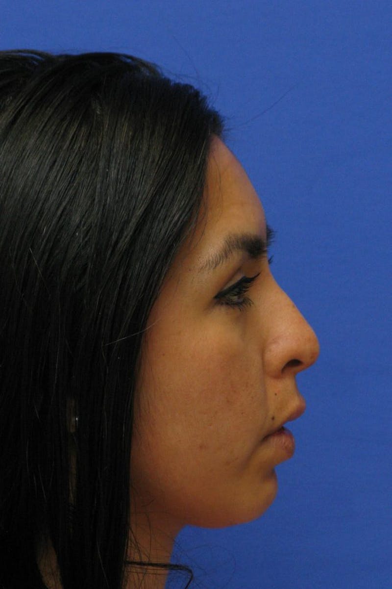 Lip Augmentation Before & After Gallery - Patient 174290 - Image 6