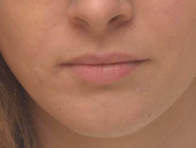 Lip Augmentation Before & After Gallery - Patient 403670 - Image 1