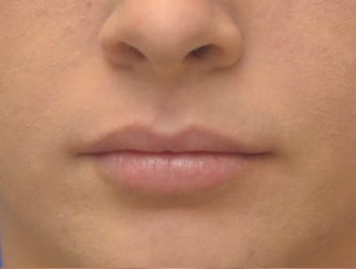 Lip Augmentation Before & After Gallery - Patient 403670 - Image 2