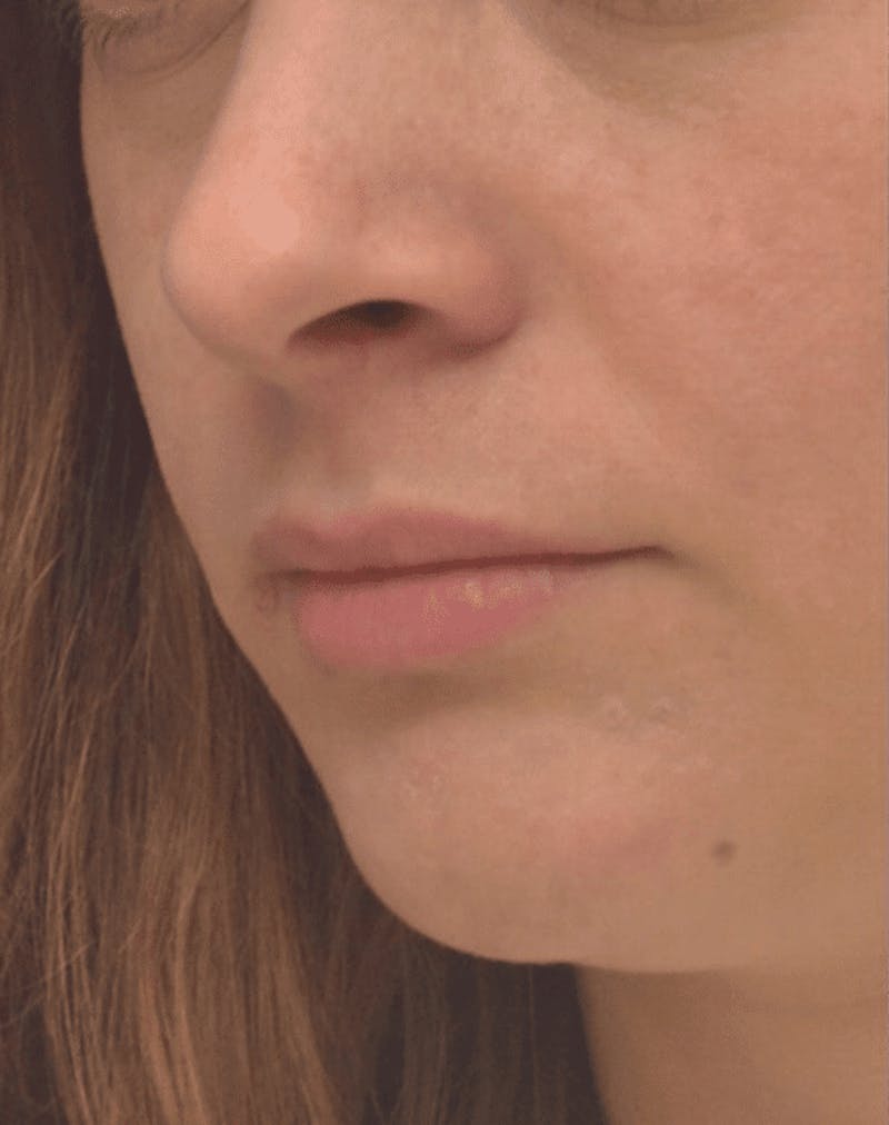 Lip Augmentation Before & After Gallery - Patient 403670 - Image 3
