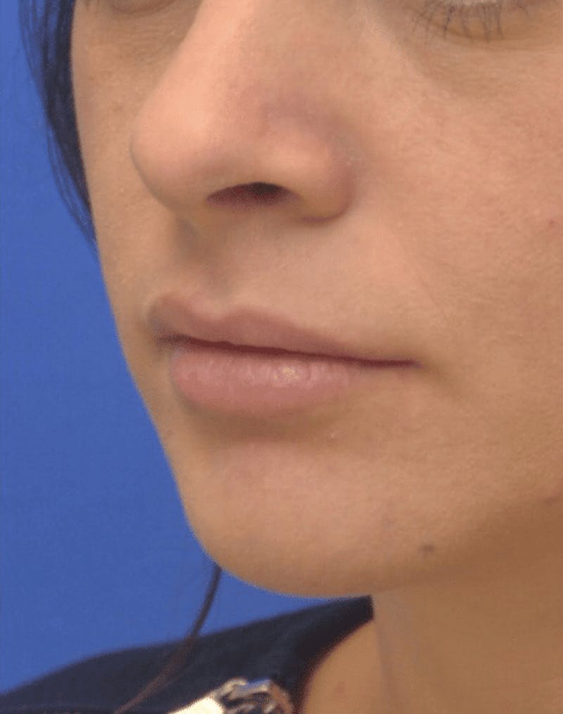 Lip Augmentation Before & After Gallery - Patient 403670 - Image 4