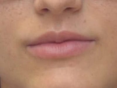 Lip Augmentation Before & After Gallery - Patient 410269 - Image 1
